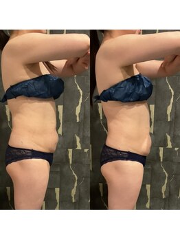 オーパス ビューティー(OPUS Beauty)/上半身体験コース1回目