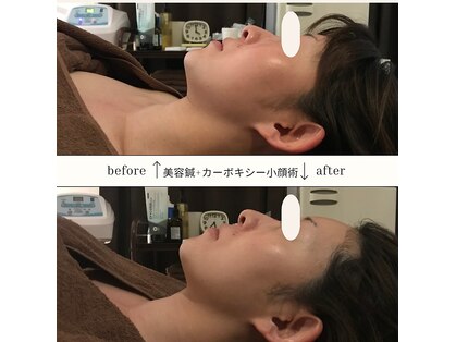 アキュリング(Aculing)の写真