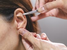 ウル(ulu)の雰囲気(金粒などを肌色のテープで貼っていきます。痛みはありません。)