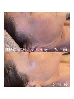 エイミー(Amy)/長年悩み[もたつきスッキリ解消]