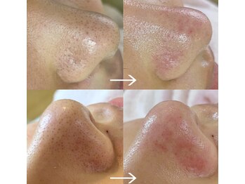 エクレ(eclat)/毛穴マシン以上の結果