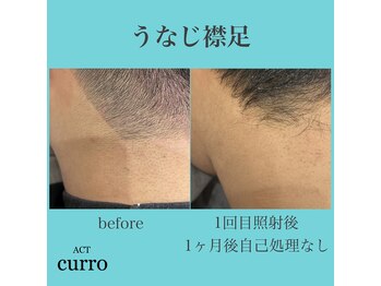 アクト クロ(ACT curro)/【うなじ襟足】脱毛施術例