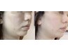 人気NO1【小顔/フェイスライン/たるみ改善】ほうれい線改善　60分 ¥11800