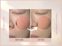 シンスプラス(SINCE+)/毛穴徹底フルコース