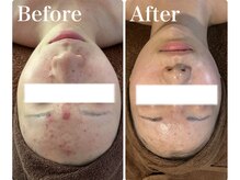 肌質改善サロン　Humming skin【3/2 NEW OPEN（予定）】/ハーブピーリング/ニキビケア