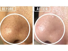 ビビ(VIVI)/毛穴ケアに◎