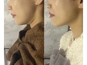 アンド(and...)の写真/二重アゴ・ほうれい線・たるみに即効アプローチ。1回で実感する小顔リフトから本格肌質改善まで。