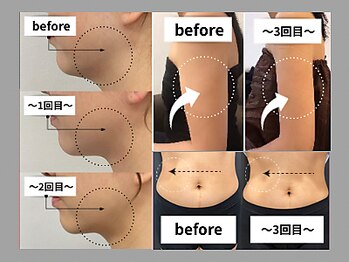 《韓国美容専門店》BELL BEAUTY SALON &nbsp;&nbsp;小顔/毛穴洗浄/シミ/痩身の写真/SNSで話題の韓国美容【小顔オンダウェーブ｜8,980円★】"結果重視"の超最新施術でたった一度でも効果実感◎