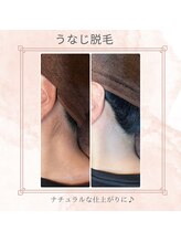 ノノ(nono)/うなじ脱毛
