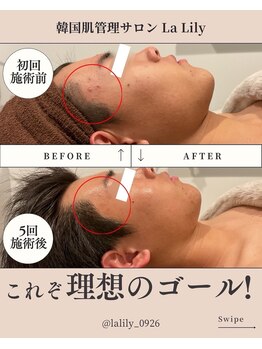 ラリリー(La Lily)/肌質改善