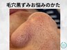 この夏にオススメ【毛穴×美白】毛穴エクストラクション＋ビタミンC生パック