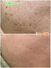 アシュレ リル 西多賀店(assure Lilou)/☆高品質ハーブピーリング☆