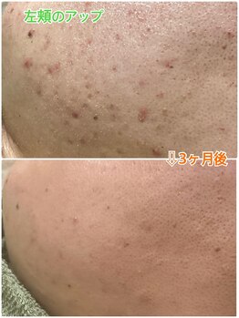 アシュレ リル 西多賀店(assure Lilou)/☆高品質ハーブピーリング☆