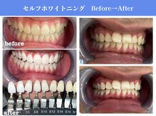 エクシアホワイトニング 岡崎店/岡崎エリア★口コミ・来店数No.1