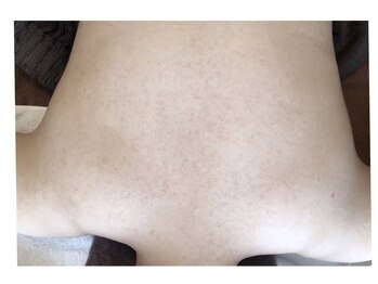 ピリナ 名古屋/【背中ハーブピーリング】症例