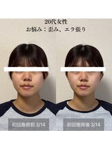 ザ リフト カドモリ 鹿児島 霧島(The Lift KADOMORI)/20代女性/歪み、エラ張り