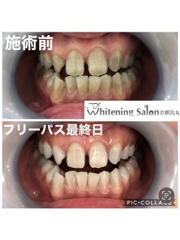 ホワイトニングサロン 京都烏丸店/ホワイトニング施術例