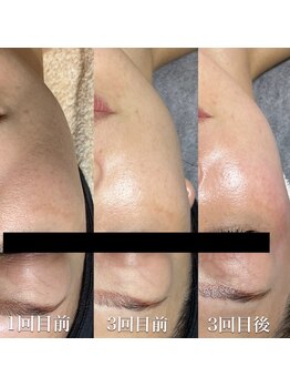 ケイリー(kaylee)/ハーブトリートメント