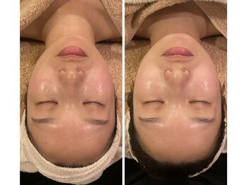 うつくし痩身 美サロン ゼットワン(Z-ONE)の写真/【自分史上最も綺麗なお肌に♪】高濃度美容液の導入×カーボキシー炭酸パック×ハイドロ毛穴洗浄¥9800