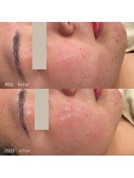 ハル(haru)/ビフォーアフター