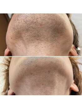 エピシアドットエヌ(epicia.N)/ヒゲ脱毛3ヶ月後