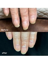 リリ(lili)/トータルハンドケア1回目