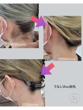 セリシエル(cericiel)/うなじ脱毛