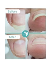 リフト 有楽町店(Re:ft)/巻き爪症例