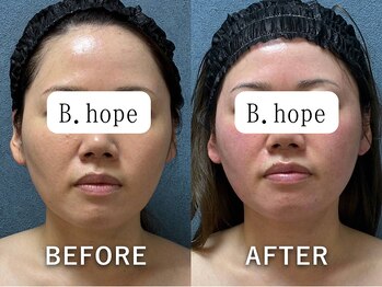 ビーホープ(B.hope)/30代モニター様1回の変化