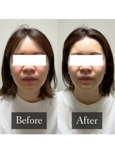 ベルフィーヌ 恵比寿店(BELFINE)/お顔引き上げ×お肌も綺麗に♪