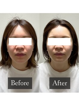 ベルフィーヌ 恵比寿店(BELFINE)/お顔引き上げ×お肌も綺麗に♪