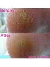 上高田つつじ整体院/フットケア　魚の目ケア　例