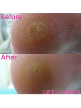 上高田つつじ整体院/フットケア　魚の目ケア　例