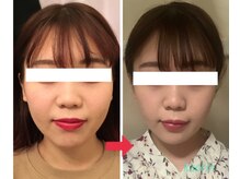 顔凛(カオリン)/20代女性の小顔矯正