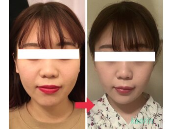 顔凛(カオリン)/20代女性の小顔矯正