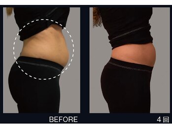 三美創ビューティースタジオ 高岡店/ワンダーシェプ 4回施術結果