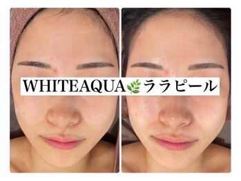 ホワイトアクア 鳳店(WHITE AQUA)/ララピール/大阪/鳳/毛穴