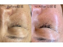 エリア(area.)/1、【シミケア35分】