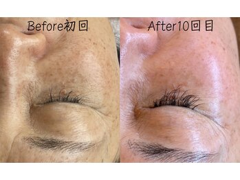 エリア(area.)/1、【シミケア35分】