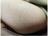 「毛孔性苔癬 」専門ケアあります！二の腕のブツブツ…本気で卒業！¥6000