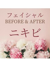 ゼロ 水戸店(ZERO)/ニキビ★before&after↓