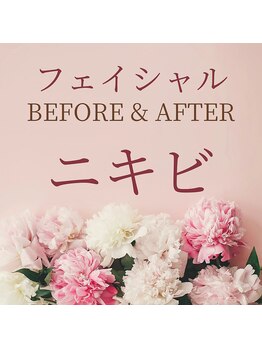 ゼロ 水戸店(ZERO)/ニキビ★before&after↓