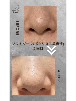 ル シャ/メンズ脱毛/毛穴洗浄/ヘッドスパ