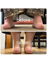 ポドウオーク(PODO WALK)/足首の変形