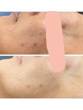 ヴィアス(VIAS)/プラズマフェイシャル　3回目