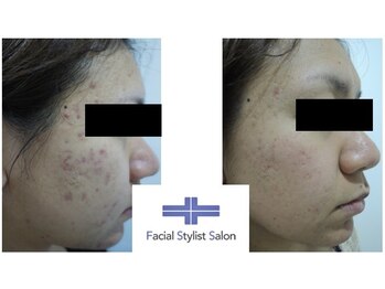 フェイシャルスタイリストサロン 高崎店(Facial Stylist Salon)/ケア例(60)