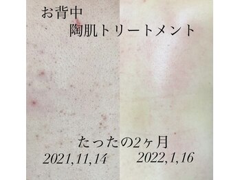 マヤヒメ(mayahime)/お背中REVIハーブピーリング