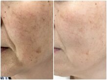 ベルネ(BELLUNE)/ベルネ式シミ改善　入賞