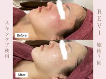 ルア(LuA.)/赤みの改善◎