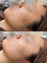 アンジェロ/【ニキビケア】肌育プログラム